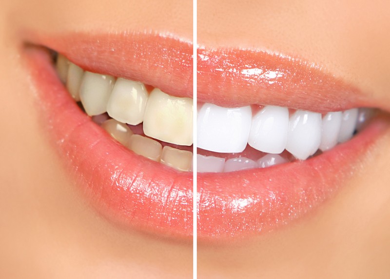 Teeth Whitening  Interlochen, MI 