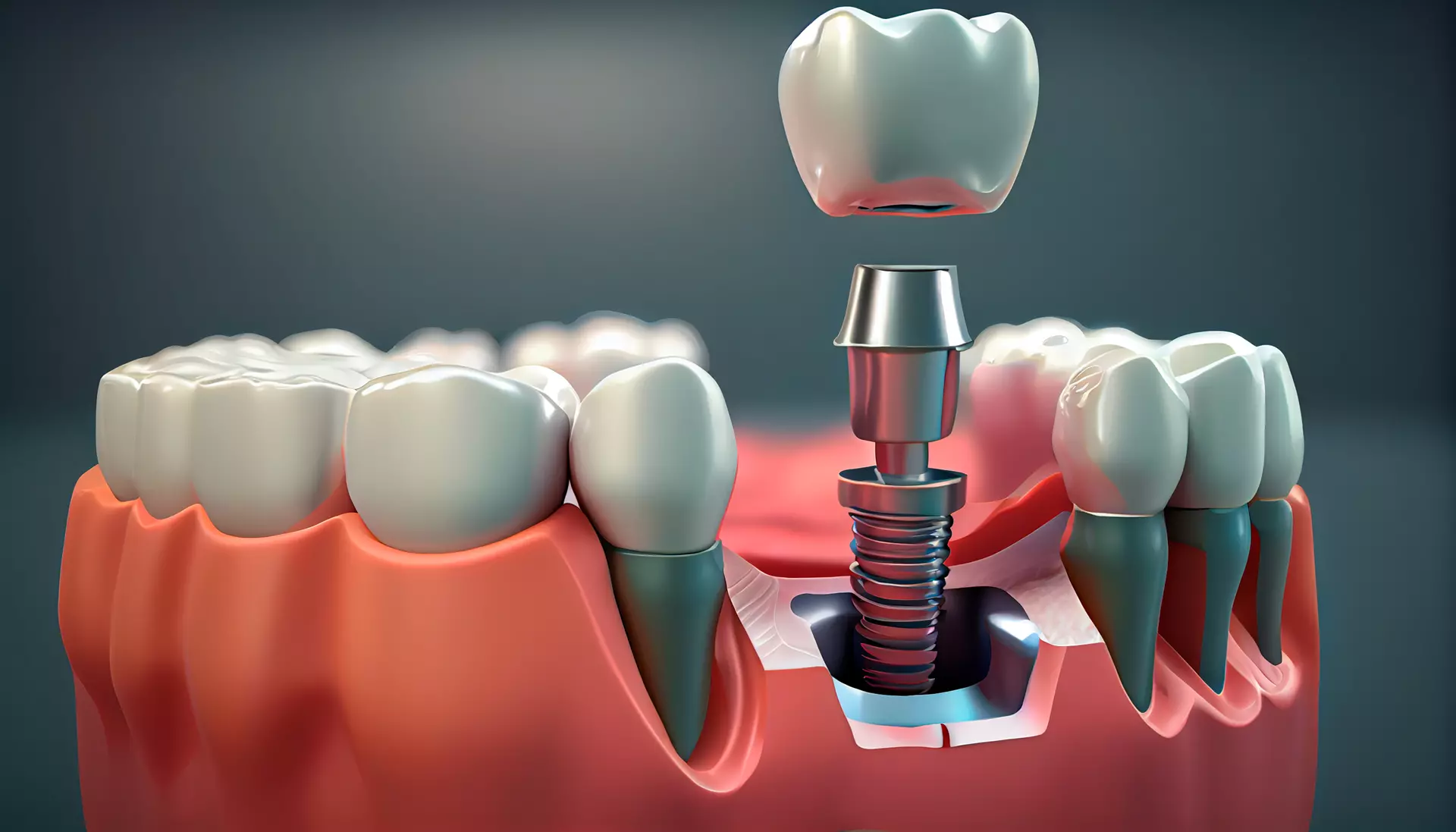 Dental Implants  Interlochen, MI 